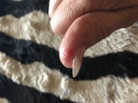 Finger Juckreiz Fingerkuppen reißen auf / Juckreiz - was kann das sein? in Nagelkrankheiten