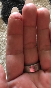 Fingerkuppe aufgerissen / Juckreiz Fingerkuppen reißen auf / Juckreiz - was kann das sein? in Nagelkrankheiten