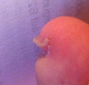 Nagel von der Seite vor dem Schneiden Fußnägel verformt in Nagelkrankheiten