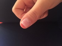 Finger sieht aufjedenfall besser aus schmerz jedoch noch höllisch Gel Nagel abgebrochen + naturnagel mit ab in Gelnägel