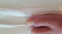 Nagelpilz und eingewachsener Nagel Fucidin Salbe / Nagelpilz und eingewachsener Nagel in Nagelkrankheiten