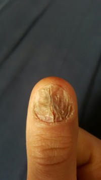 verletzter Nagel Hilfe bei furchtbarem Spaltnagel in Nägel kauen