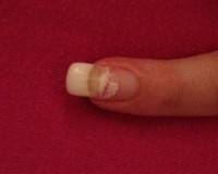 Eingerissener Nagel (kleiner Finger) Nagel böse eingerissen in Nagelmodellagen