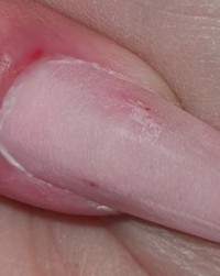 Verletzungen Löcher in der Nagelplatte in Nagelmodellagen