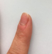 Zeigefinger 1 Nagelhaut wächst nicht mehr nach in Nägel kauen