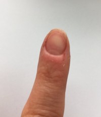 Zeigefinger 1 Nagelhaut wächst nicht mehr nach in Nägel kauen