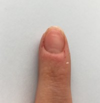 Zeigefinger 2 Nagelhaut wächst nicht mehr nach in Nägel kauen