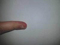 Nagel 5 Fingernägel für immer zerstört? in Nägel kauen