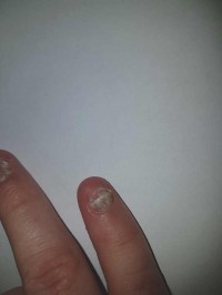 Wächst nicht nach fingernagel ▷ Fingernägel