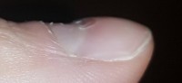 Daumen Seite Plötzlich Loch in Nagelplatte in Nagelkrankheiten