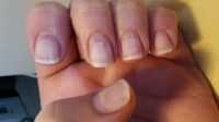 Linke Hand nach der Gelnägel Entfernung GelNägel entfernt, jetzt schmerzen und Verfärbungen in Maniküre
