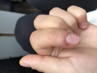 Zeigefinger mit dunkler stelle am Nagelwall Zeigefinger dunkel /Mittelfinger wächst komisch in Nagelkrankheiten