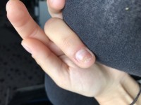 Ehemalig gequetschter Mittelfinger Zeigefinger dunkel /Mittelfinger wächst komisch in Nagelkrankheiten