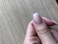 Es schimmert leicht der gelbliche Streifen (horizontal) in der Mitte des Nagels  Nagelpilz unter den Acrylnägeln? in Nagelkrankheiten