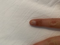 Nagel mit strichen Schwarze Striche in diversen Fingernägeln ? in Nagelkrankheiten