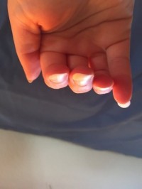 Nagel des Mittelfingers besonders stark betroffen Einseitig nach unten gebogener Fingernagel in Nagelkrankheiten