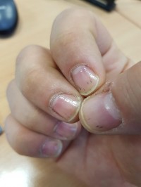 Striche/Linien auf/unter dem Fingernagel 2 Schwarze Striche/Linien unter/auf dem Nagel in Nagelkrankheiten