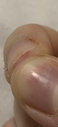 Rote Striche Rötliche Streifen unterm Fingernagel , tut weh in Nagelkrankheiten