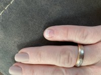 Kleiner Finger Hohlräume in Nagelkrankheiten