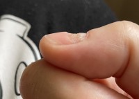 Kf Nagelmodellage auf kaputten Nagelbett möglich? in Nagelmodellagen
