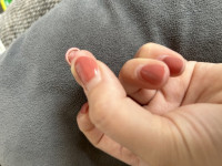 1 Überschüssige Haut unter Nagel in Nagelkrankheiten