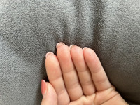 2 Überschüssige Haut unter Nagel in Nagelkrankheiten