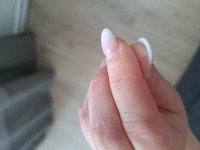 Haut Daumen Haut Fingerkuppen löst sich nach Modellage in Nagelkrankheiten
