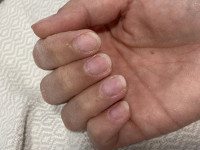 Rechte hand Nagelkrankheit v Gelnägel? in Nagelkrankheiten