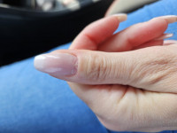 Daumen links was ist das? naturnagel verformt? in Nagelkrankheiten