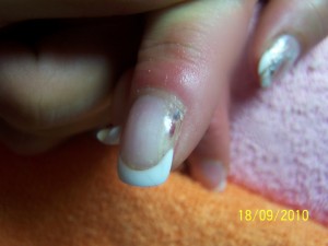 1.ansicht nagelpilz? in Nagelkrankheiten