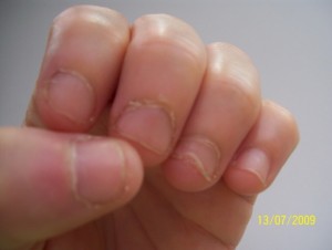 linke Hand 13.07.09die Nägel waschsen besonders die Nagelhaut und der untere  Mit 40 Nägel kauen in Nägel kauen