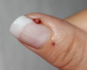 Fleisch nagelbettentzündung finger wildes am Fingernagel?