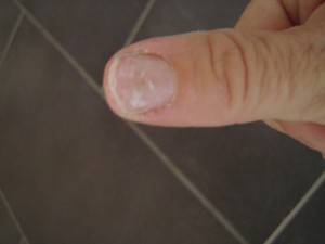 Fingernagel eiter unterm Äußerliche Symptome: