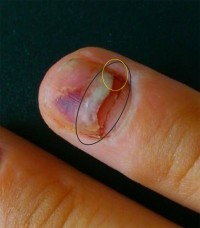 Überlappende Nagelplatten Fast gelöster Nagel mit Acryl / Gel? in Nagelkrankheiten