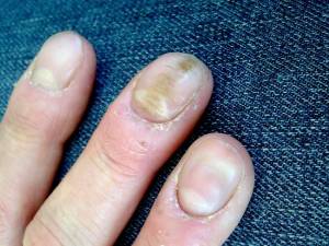 verformte nägel 1 Auf diese  kranken Nägel eine Gelmodellage? in Nagelkrankheiten