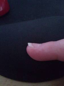 Wölbung auf der Nagelplatte rechts Ringfinger gleiches auf
links kleiner  Gel vs. Acryl bei unebenen Nägeln mit Rillen?! in Gelnägel