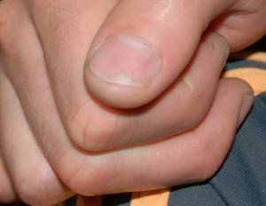 Naturnagel mit beschädigtem Nagelbett Kann man das entfernen in Nagelkrankheiten