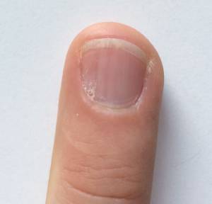 Rillen mit trockenem Nagelbett Tiefe Rillen am Nagel des Mittelfingers in Nagelkrankheiten