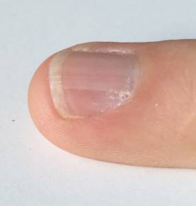 Seitenansicht: Rillen sind relativ tief Tiefe Rillen am Nagel des Mittelfingers in Nagelkrankheiten