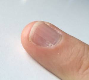Hautschuppen, die mit der Rille herauswachsen Tiefe Rillen am Nagel des Mittelfingers in Nagelkrankheiten