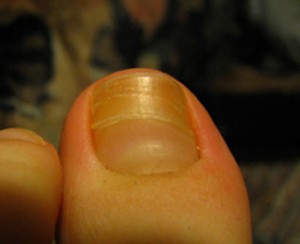Fußnagel links Probleme mit Zehennägel in Pediküre