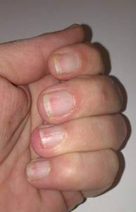 Nägel etwas genauer Ruinierte Nägel - wie lackieren oder besser nicht? in Nagellack / UV
