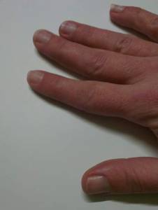 rechte Hand Ruinierte Nägel - wie lackieren oder besser nicht? in Nagellack / UV