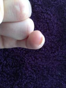 Der kleine Finger von vorne. 1. Versuch (Refill) mit PNS Welness-Collection in Anfänger Nageldesign