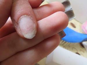 beschädigter Naturnagel 2 brüchiger Nagel.was meinbt ihr dazu? in Nagelkrankheiten