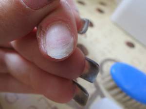 beschädigter Naturnagel brüchiger Nagel.was meinbt ihr dazu? in Nagelkrankheiten