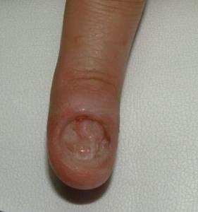Abgeschälter Naturnagel Schlimme Nägel - zum Arzt geschickt in Nagelkrankheiten