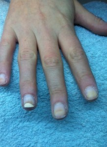 Fingernagel / Nagel Verfärbung Naturnagelverfärbung - was kann das sein? in Nagelkrankheiten