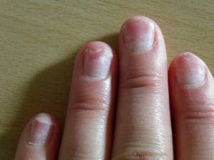 Linke Hand: Ringfinger hatte ein Greenie, Kleiner Finger löst sich NN etwas.  Greenie behandelt, Onycholyse noch da, wie pflegen in Nagelkrankheiten