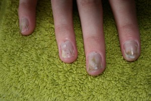 plaknagels1 Grüner Nagel unter Kunstnägeln in Nagelkrankheiten